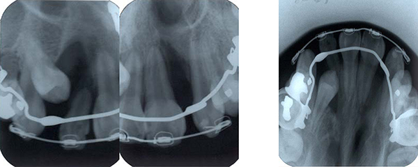 顎裂部骨移植前の拡大と排列終了時のＸ線写真